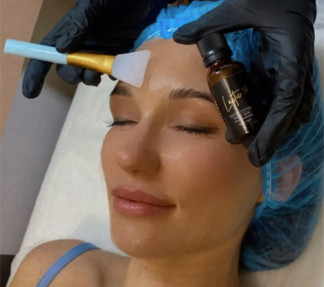 Online Seminar Säure Peeling